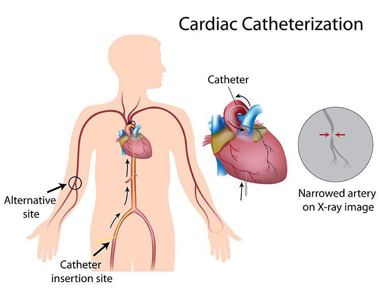 CT CardiacCatheterization-lg